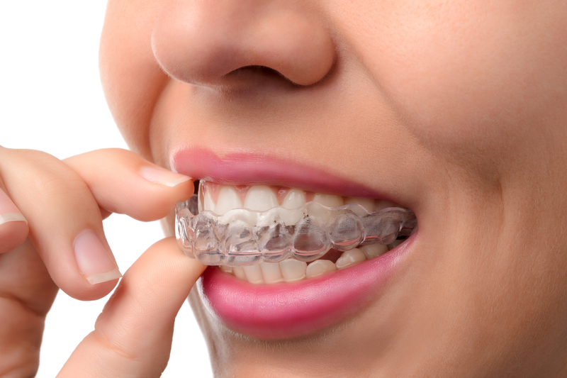 Advantages of Cleaning Invisalign at Home